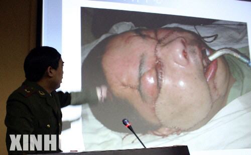 4月14日，西安西京醫院整形外科主任郭樹忠在介紹患者術後狀況。 當日，陝西省西安西京醫院爲一位雲南傈僳族男性患者完成“換臉”手術，這是國內首例爲人“換臉”的手術。手術於4月13日開始，持續約14個小時，到14日早晨結束。接受手術的傈僳族青年李國興今年30歲，來自雲南省蘭坪白族普米族自治縣。兩年前，李國興遭遇到國家二級保護動物黑熊的襲擊，最終導致自己顏面部受到嚴重毀容性外傷。在一家國際公益性環保組織的幫助下，他來到西安接受“換臉”手術。