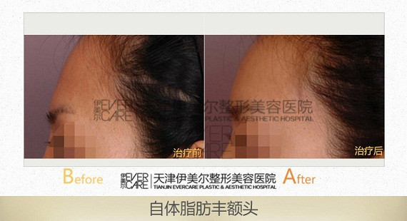 天津伊美尔自体脂肪填充