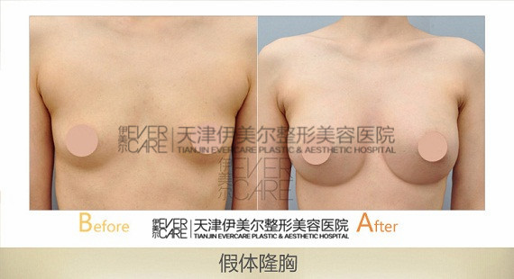 天津伊美尔隆胸