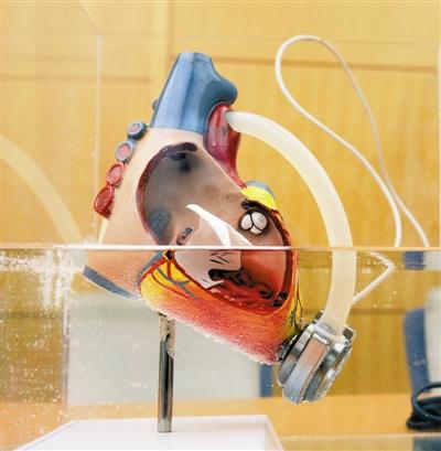 第一颗拥有独立自主知识产权的“人造心脏”：天津“火箭心”