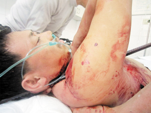 坠落,被直径2厘米的钢筋刺穿其身体和面部,幸运的是钢筋并未伤及骨骼